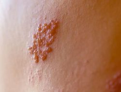5 tanda herpes awal, jangan lewatkan!